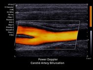 Ультразвуковое исследование артерии
