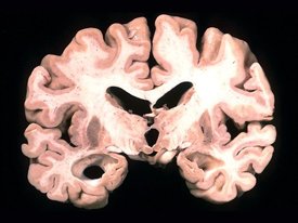 У погибших от болезни Альцгеймера в мозге находят грибы